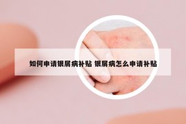 如何申請(qǐng)銀屑病補(bǔ)貼 銀屑病怎么申請(qǐng)補(bǔ)貼
