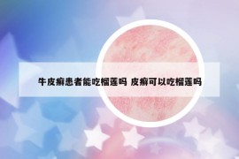 牛皮癬患者能吃榴蓮嗎 皮癬可以吃榴蓮嗎