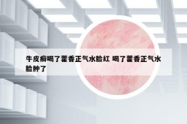 牛皮癬喝了藿香正氣水臉紅 喝了藿香正氣水臉腫了