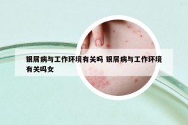 銀屑病與工作環(huán)境有關(guān)嗎 銀屑病與工作環(huán)境有關(guān)嗎女