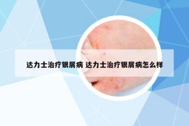 達(dá)力士治療銀屑病 達(dá)力士治療銀屑病怎么樣