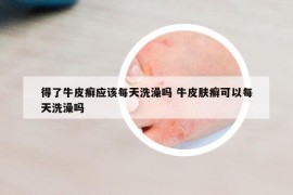 得了牛皮癬應(yīng)該每天洗澡嗎 牛皮膚癬可以每天洗澡嗎
