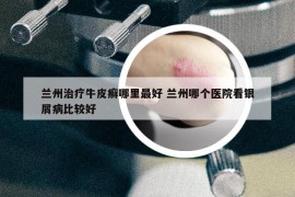 蘭州治療牛皮癬哪里最好 蘭州哪個(gè)醫(yī)院看銀屑病比較好