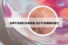 治理牛皮癬的法律依據(jù) 治療牛皮病癬的偏方