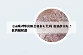 泡溫泉對牛皮癬患者有好處嗎 泡溫泉治好了我的銀屑病
