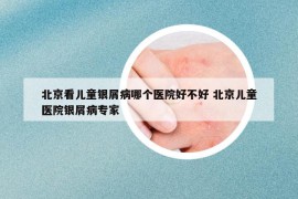 北京看兒童銀屑病哪個(gè)醫(yī)院好不好 北京兒童醫(yī)院銀屑病專家