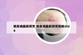 銀屑病最新研究 銀屑病最新研究突破2024