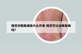 槐花對銀屑病有什么作用 槐花可以治銀屑病嗎?