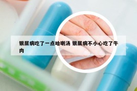 銀屑病吃了一點哈喇湯 銀屑病不小心吃了牛肉