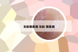 石斛銀屑病 石斛 銀屑病