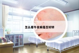怎么看牛皮癬是否好轉(zhuǎn)