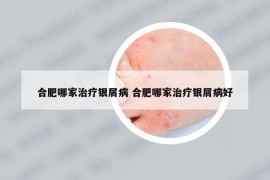 合肥哪家治療銀屑病 合肥哪家治療銀屑病好