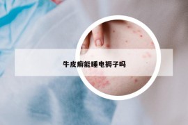 牛皮癬能睡電褥子嗎