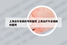 上海治牛皮癬的專職醫(yī)院 上海治療牛皮病癬的醫(yī)院