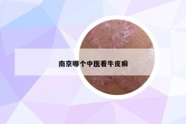 南京哪個(gè)中醫(yī)看牛皮癬