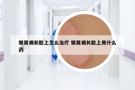銀屑病長臉上怎么治療 銀屑病長臉上用什么藥