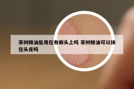 茶樹精油能用在有癬頭上嗎 茶樹精油可以抹在頭皮嗎