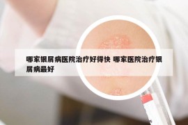 哪家銀屑病醫(yī)院治療好得快 哪家醫(yī)院治療銀屑病最好