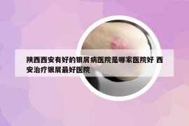 陜西西安有好的銀屑病醫(yī)院是哪家醫(yī)院好 西安治療銀屑最好醫(yī)院