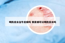 喝陳皮水治牛皮癬嗎 銀屑病可以喝陳皮水嗎
