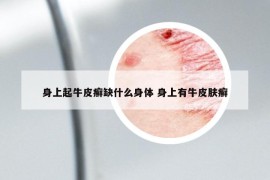 身上起牛皮癬缺什么身體 身上有牛皮膚癬