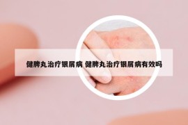 健脾丸治療銀屑病 健脾丸治療銀屑病有效嗎