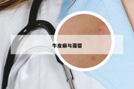 牛皮癬與葆嬰