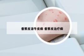 香蕉皮涂牛皮癬 香蕉皮治療癬