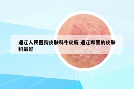通遼人民醫(yī)院皮膚科牛皮癬 通遼哪里的皮膚科最好