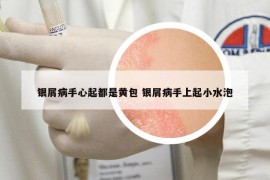 銀屑病手心起都是黃包 銀屑病手上起小水泡
