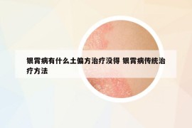 銀霄病有什么土偏方治療沒得 銀霄病傳統(tǒng)治療方法