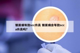 銀屑病導(dǎo)致scc升高 銀屑病會(huì)導(dǎo)致scca升高嗎?