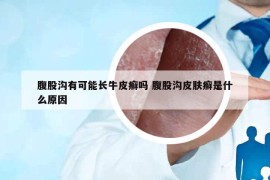 腹股溝有可能長(zhǎng)牛皮癬嗎 腹股溝皮膚癬是什么原因