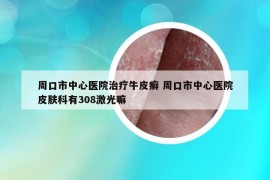 周口市中心醫(yī)院治療牛皮癬 周口市中心醫(yī)院皮膚科有308激光嘛