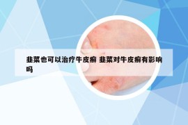韭菜也可以治療牛皮癬 韭菜對(duì)牛皮癬有影響嗎