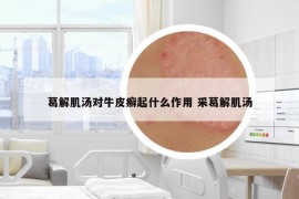 葛解肌湯對(duì)牛皮癬起什么作用 采葛解肌湯