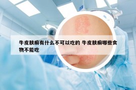 牛皮膚癬有什么不可以吃的 牛皮膚癬哪些食物不能吃