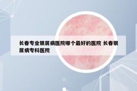 長春專業(yè)銀屑病醫(yī)院哪個最好的醫(yī)院 長春銀屑病?？漆t(yī)院