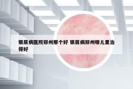 銀屑病醫(yī)院鄭州那個好 銀屑病鄭州哪兒里治得好