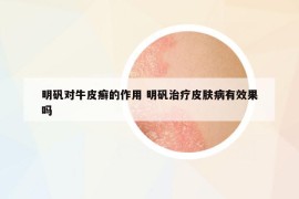 明礬對牛皮癬的作用 明礬治療皮膚病有效果嗎