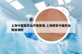 上海中醫(yī)醫(yī)院治療銀屑病 上海哪家中醫(yī)院治銀屑病好