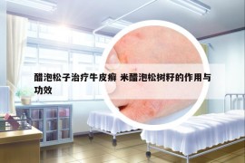 醋泡松子治療牛皮癬 米醋泡松樹籽的作用與功效