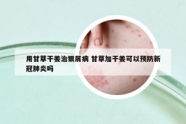 用甘草干姜治銀屑病 甘草加干姜可以預(yù)防新冠肺炎嗎