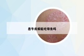患牛皮癬能吃帶魚嗎