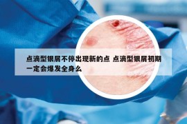 點滴型銀屑不停出現(xiàn)新的點 點滴型銀屑初期一定會爆發(fā)全身么