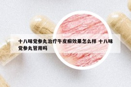 十八味黨參丸治療牛皮癬效果怎么樣 十八味黨參丸管用嗎