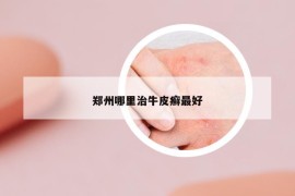 鄭州哪里治牛皮癬最好