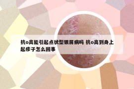 抗o高能引起點狀型銀屑病嗎 抗o高到身上起疹子怎么回事