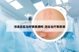 泡澡出能治好銀屑病嗎 泡浴治療銀屑病