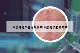 螨蟲皂能不能治銀屑病 螨蟲皂洗臉的功效